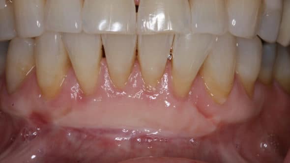 Mucogingival Therapy - Gum Disease - Gingivitis