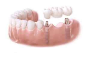 full arch implant