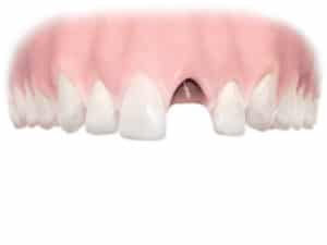 Single tooth missing