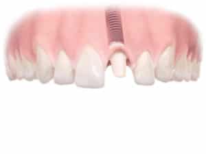 single tooth implant