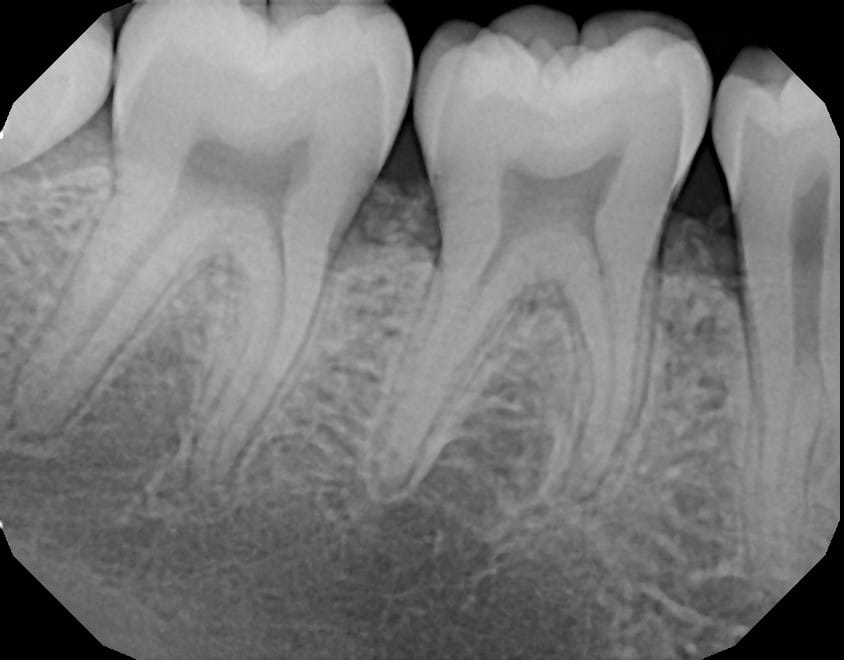 teeth x-ray