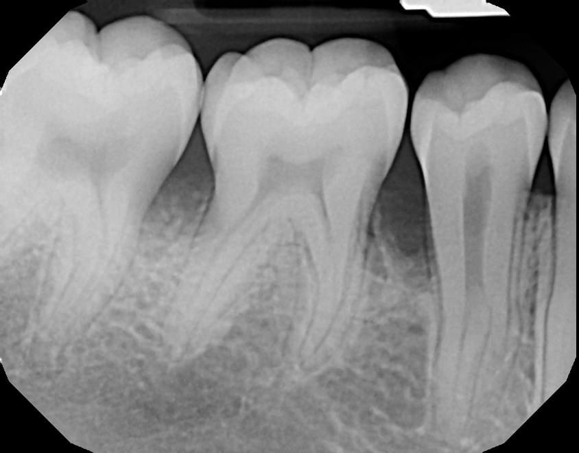 teeth x-ray