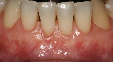 Allograft after