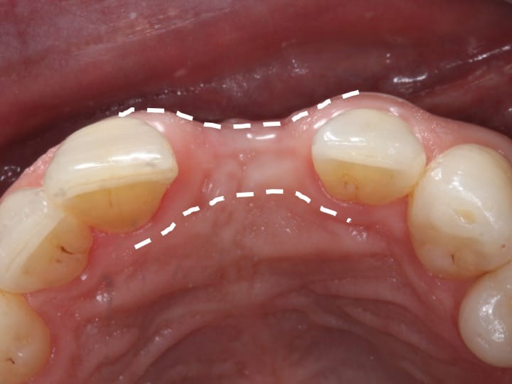 ridge augmentation