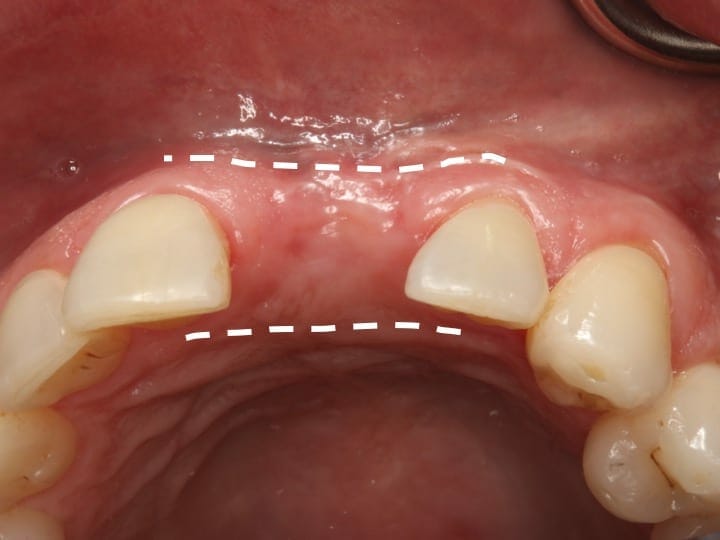 ridge augmentation