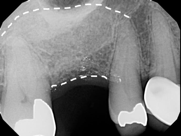 sinus graft after