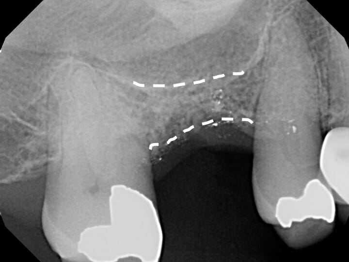 sinus graft before