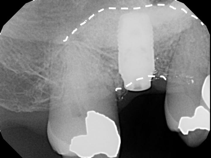 sinus graft implant