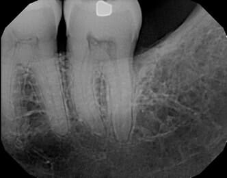 xray of two teeth with roots showing after